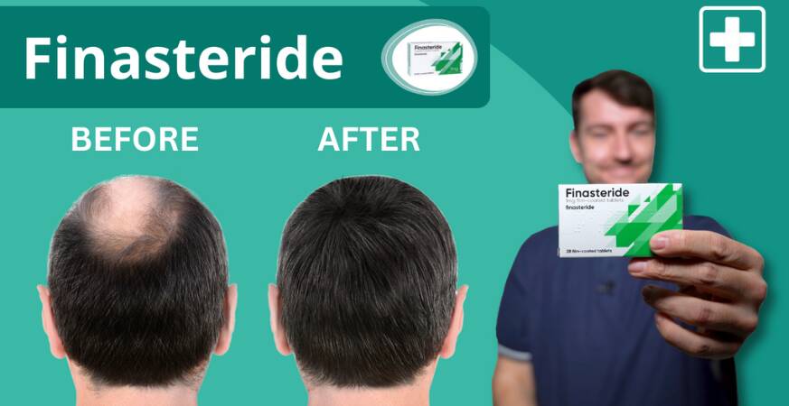 Video guide: finasteride (hair loss tablets)