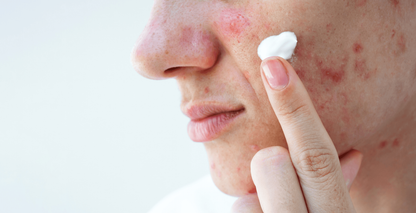 Acne treatments explained